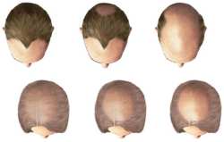 Male hair loss (androgenic alopecia) can also affect women