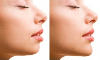 Before & after pictures of chin augmentation