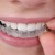 Techniques and options of dental braces