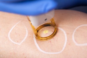 How laser treatment of thread veins is performed