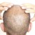 Hair transplant aftercare and recovery