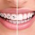 Introduction to orthodontic treatment with braces