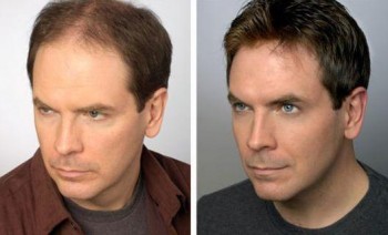 Hair replacement – not the same as the traditional toupee